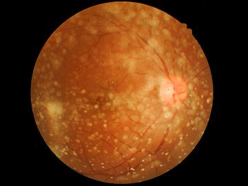 Inteligência Artificial Acelera Diagnóstico de Retinopatia Diabética sem Especialista