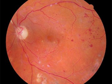 Estatinas, Fibratos, Reduzem os Riscos de Retinopatia Diabética em Pacientes Diabéticos