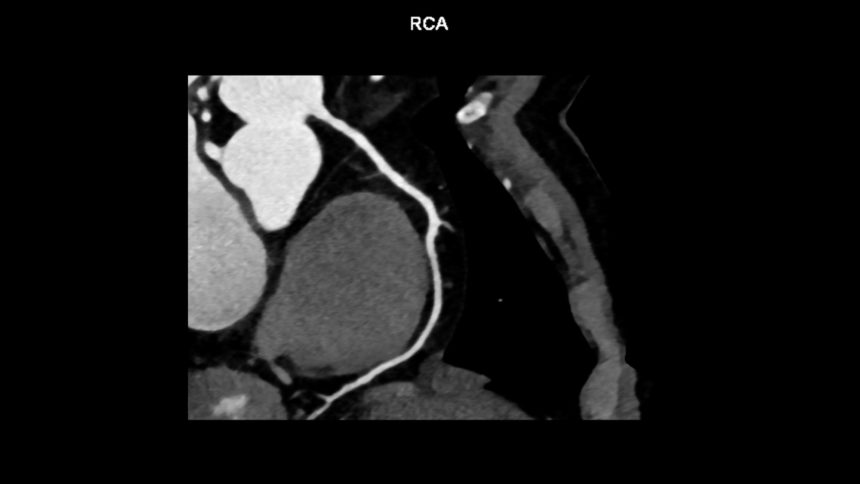 Angiografia por Tomografia Computadorizada Pode ser Preferível ao Teste de Estresse Funcional para Avaliação da Dor Torácica no Diabetes