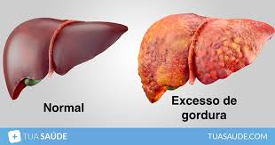 Ação Precoce Necessária para Prevenção e Controle do Fígado Gordo no Diabetes Tipo 2