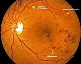 Diabetes Tipo 2 Diagnosticado Mais Cedo na Vida Aumenta a Probabilidade de Retinopatia