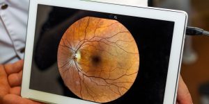 Degeneração Macular Relacionada à Idade Fortemente Associada a Formas Graves de Doença Cardiovascular